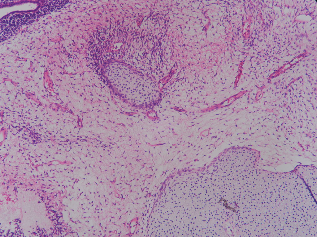 SARCOMA BOTRYOIDES (EMBRYONAL RHABDOMYOSARCOMA ) – CERVIX ...