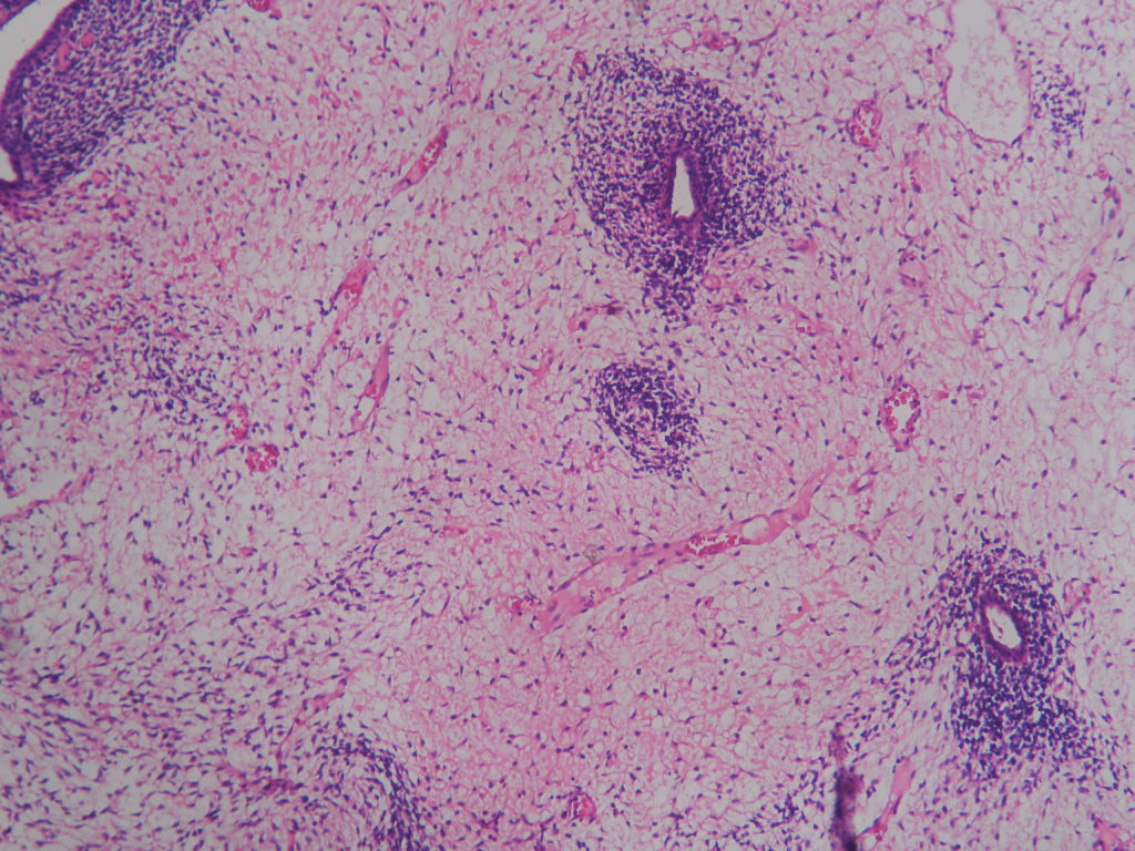 SARCOMA BOTRYOIDES (EMBRYONAL RHABDOMYOSARCOMA ) – CERVIX ...