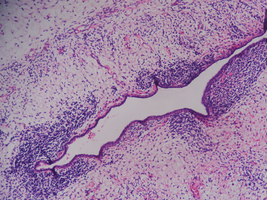 SARCOMA BOTRYOIDES (EMBRYONAL RHABDOMYOSARCOMA ) – CERVIX ...