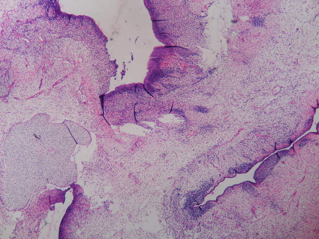 SARCOMA BOTRYOIDES (EMBRYONAL RHABDOMYOSARCOMA ) – CERVIX