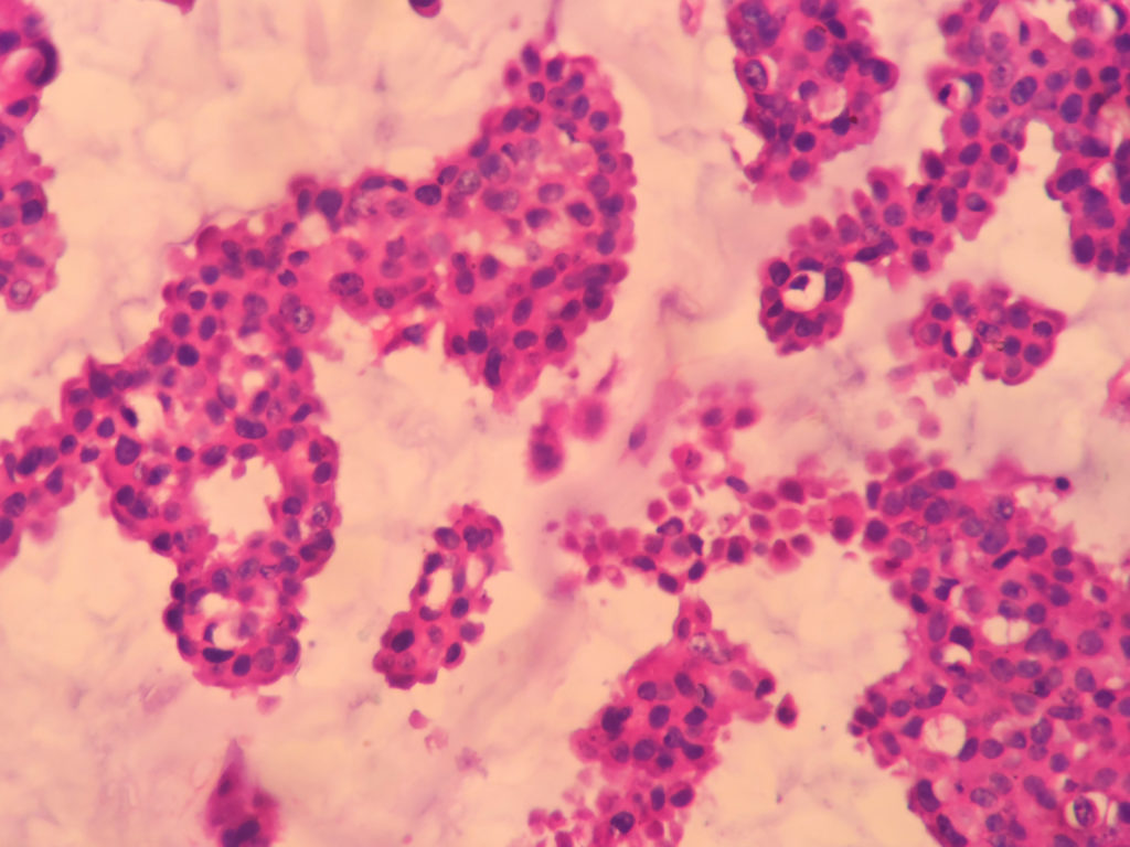 MUCINOUS CARCINOMA – Histopathology.guru