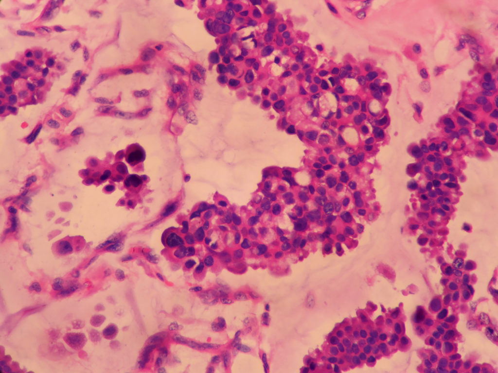 MUCINOUS CARCINOMA – Histopathology.guru