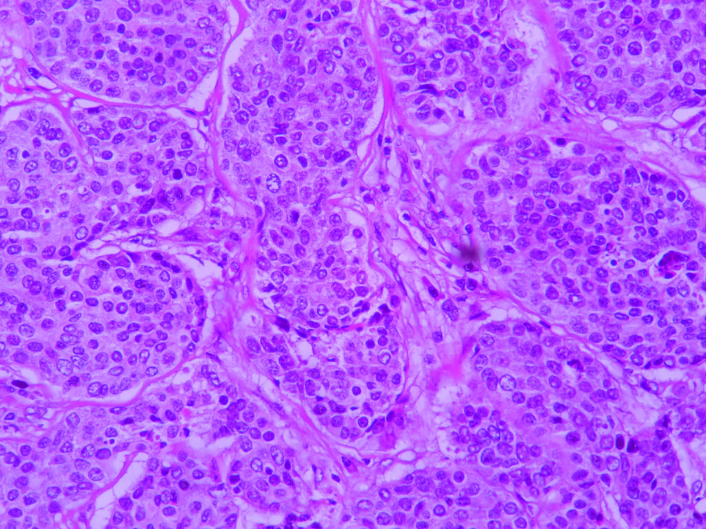 Adenocarcinoma NOS – Histopathology.guru