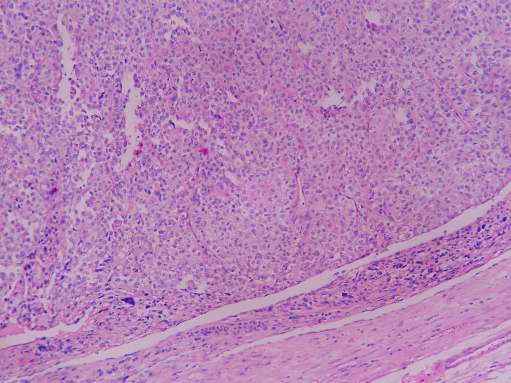 Pheochromocytoma – Histopathology.guru