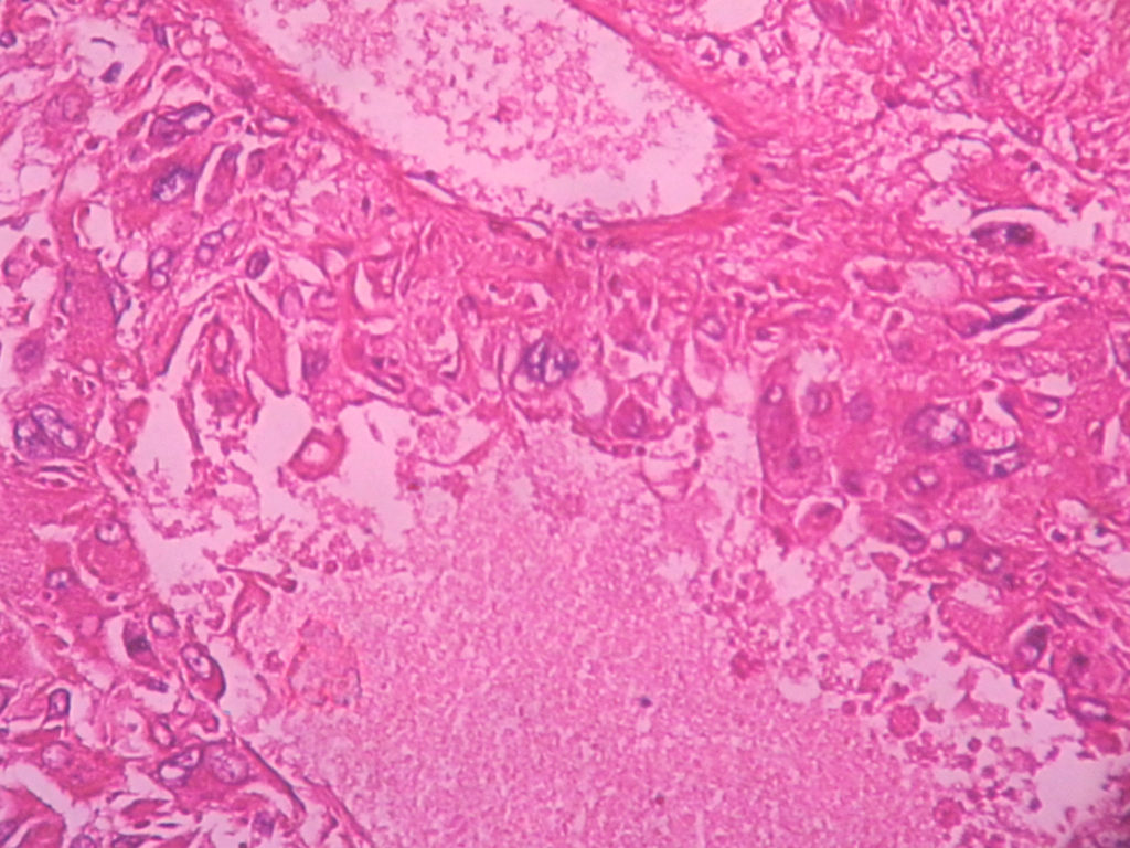 Pheochromocytoma – Histopathology.guru