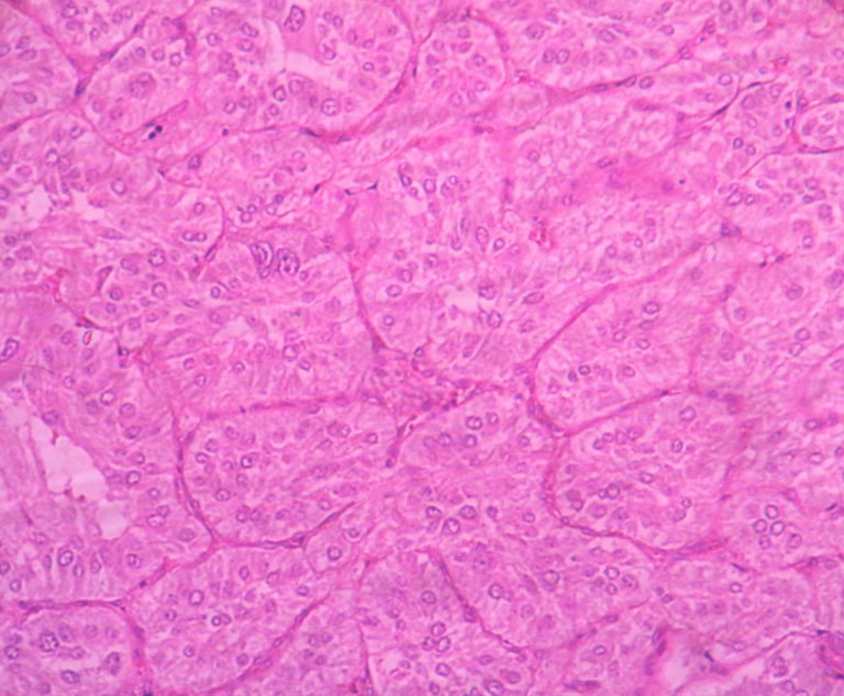 Pheochromocytoma Histopathologyguru 5595