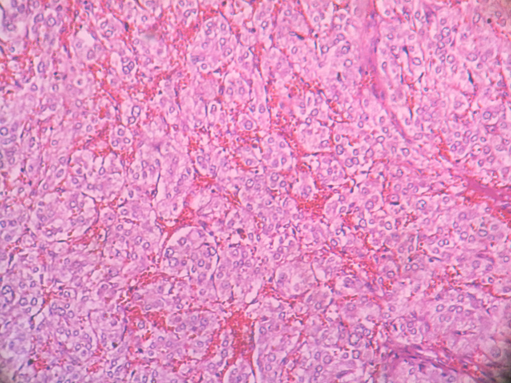 Pheochromocytoma Histopathologyguru 1946