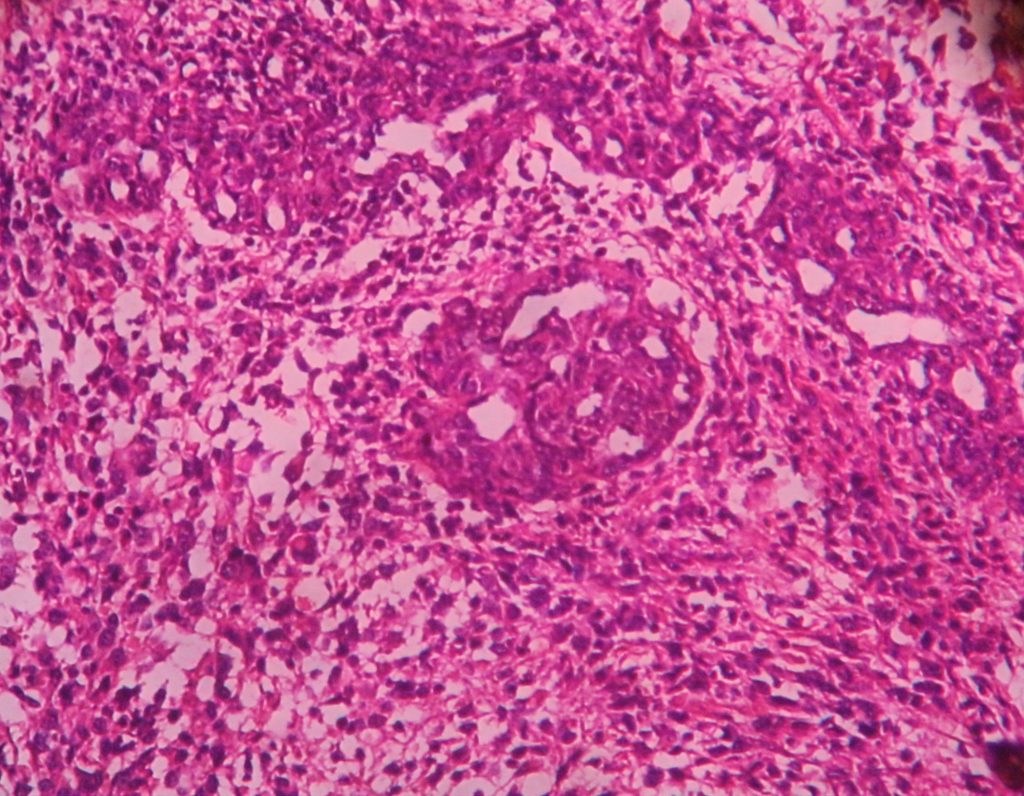 GLIOBLASTOMA – Histopathology.guru