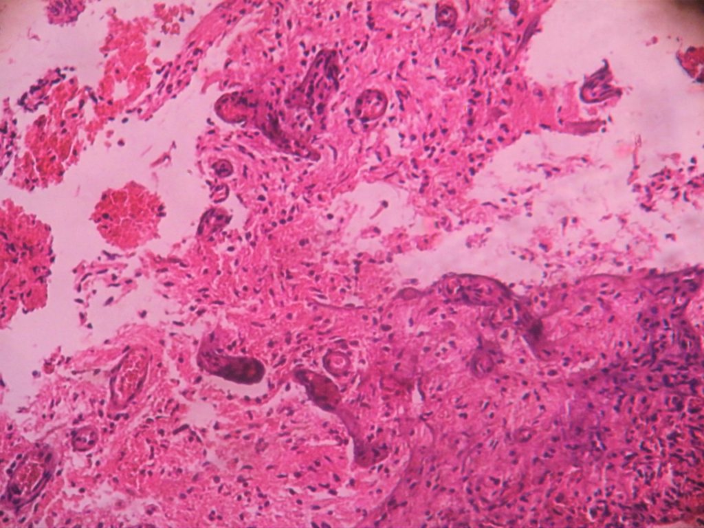 GLIOBLASTOMA – Histopathology.guru