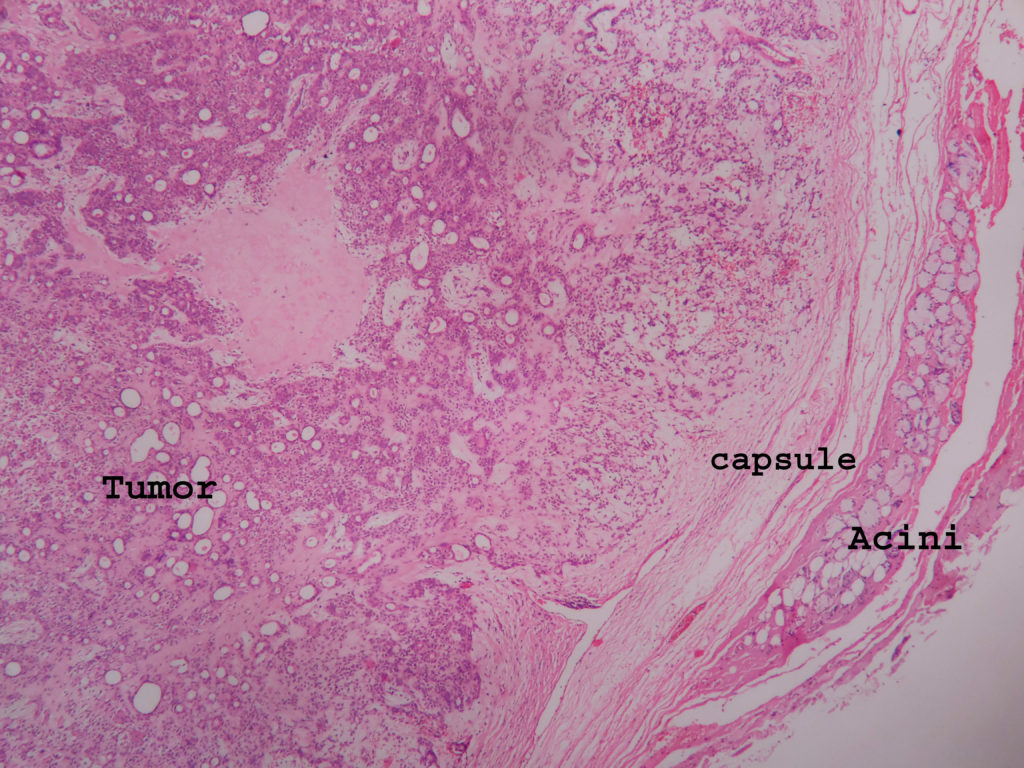 Pleomorphic Adenoma Histopathology Guru