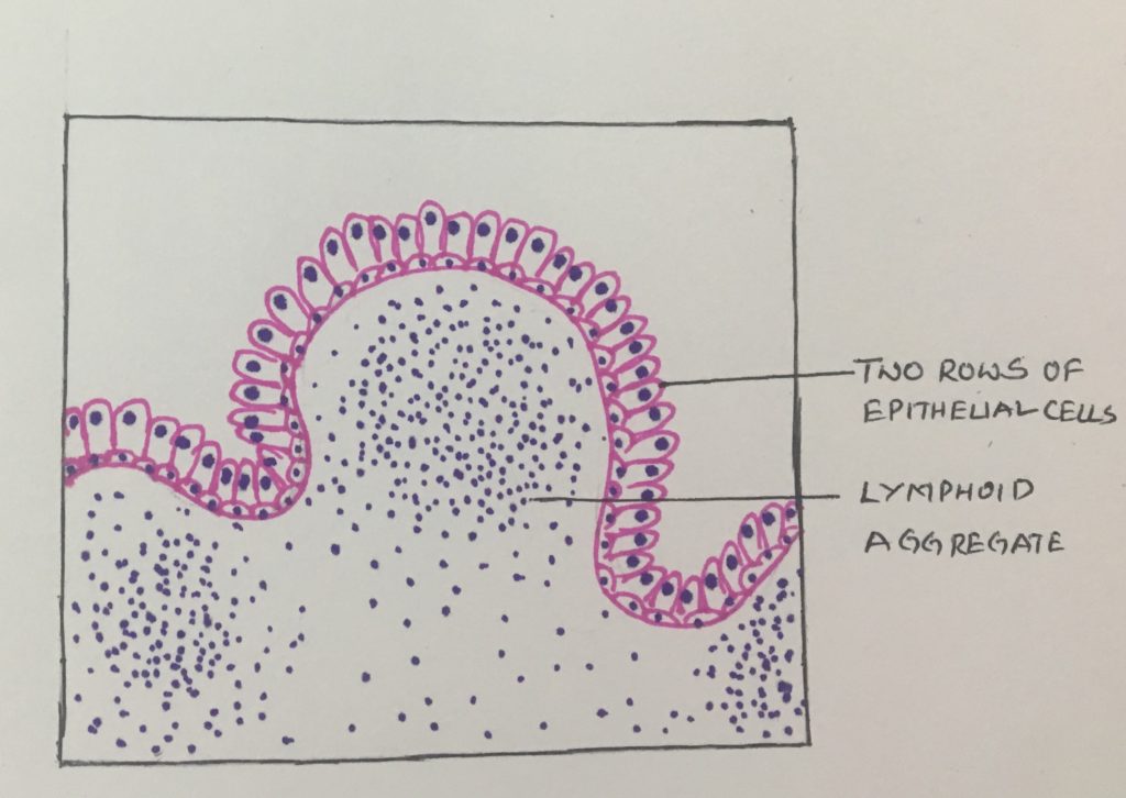 Warthins Tumor Histopathologyguru