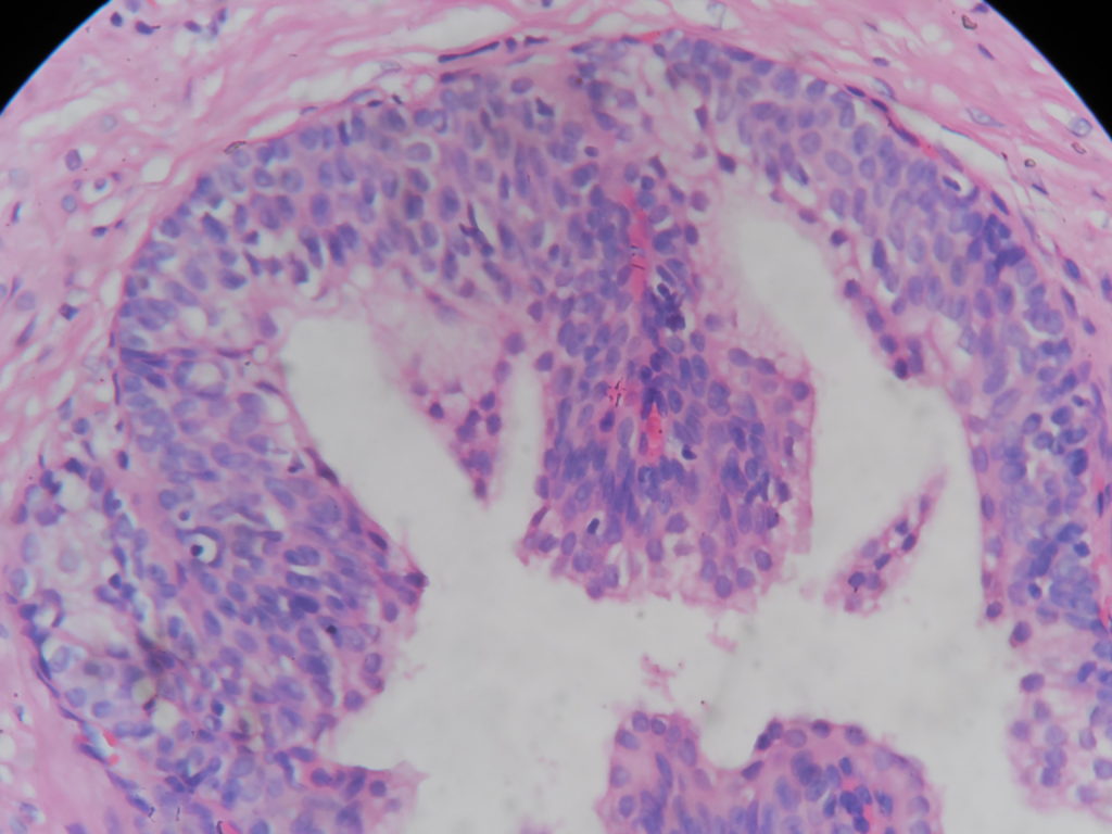 Basal cell hyperplasia – prostate – Histopathology.guru