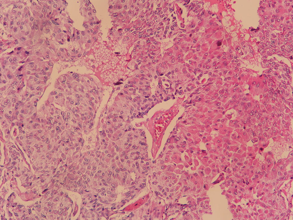 Adrenal cortical carcinoma Histopathology.guru