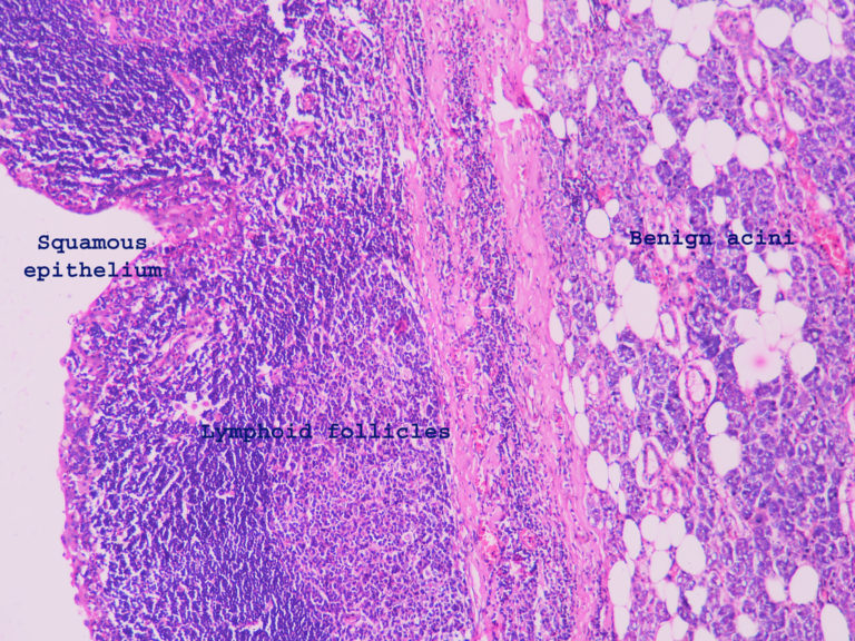 Lymphoepithelial cyst of Parotid – Histopathology.guru