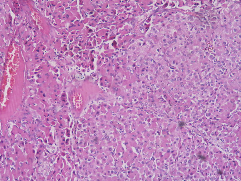 Adrenal cortical carcinoma – Histopathology.guru