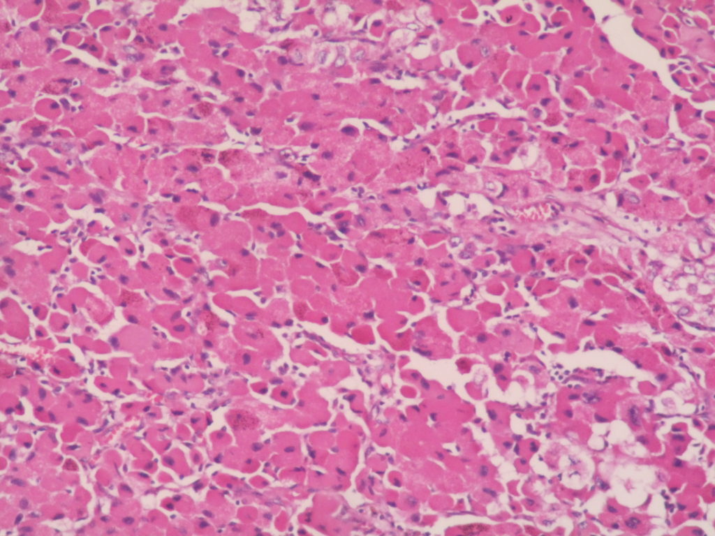 Adrenal cortical carcinoma – Histopathology.guru