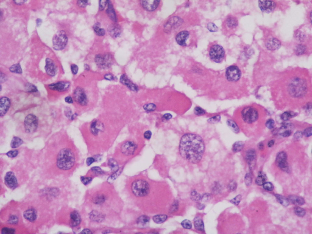 Adrenal cortical carcinoma – Histopathology.guru