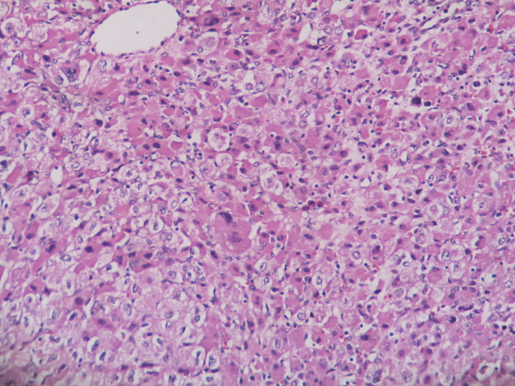 Adrenal cortical carcinoma – Histopathology.guru