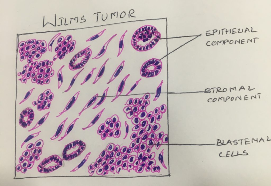 WILMS TUMOR – Histopathology.guru