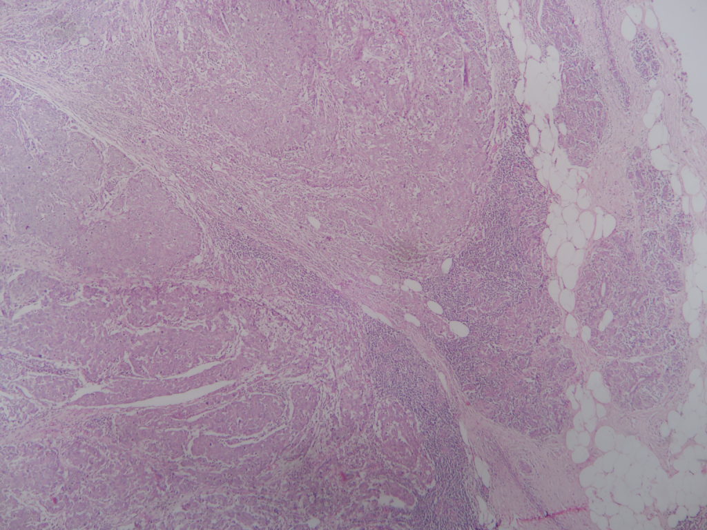 Medullary carcinoma – breast – Histopathology.guru