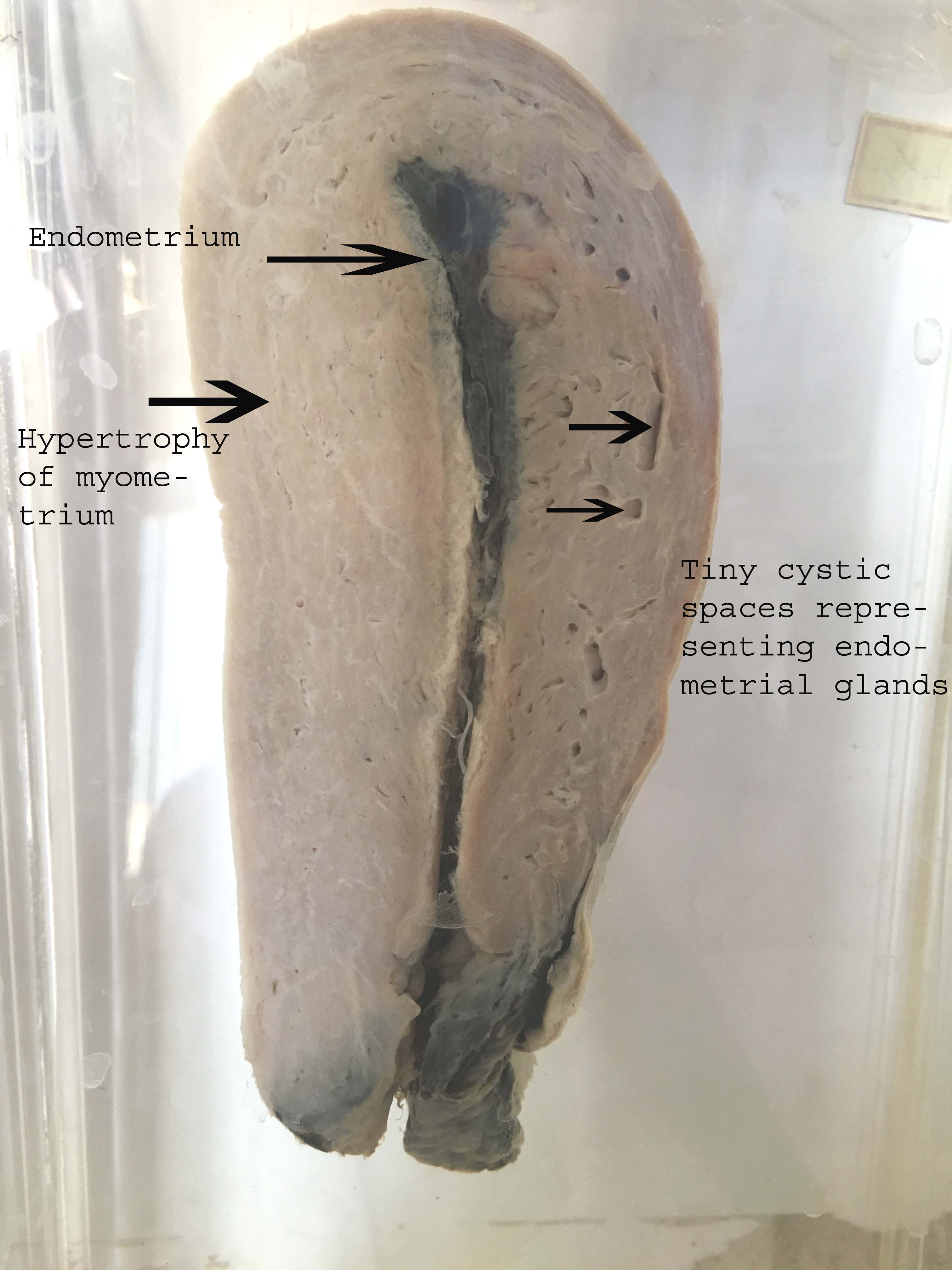 Adenomyosis – gross – Histopathology.guru