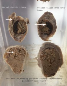 papillary carcinoma of thyroid gross