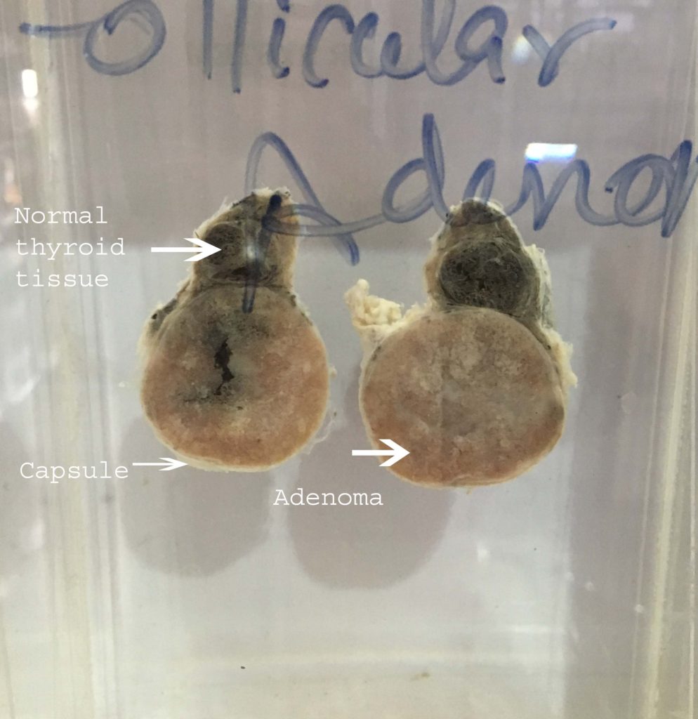 Adenoma of Thyroid – gross – Histopathology.guru