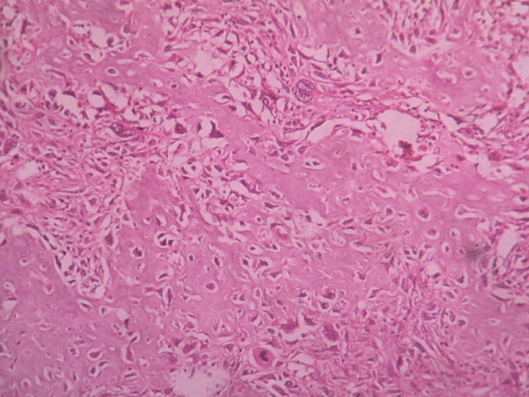 Chondrosarcoma 6 – Histopathology.guru