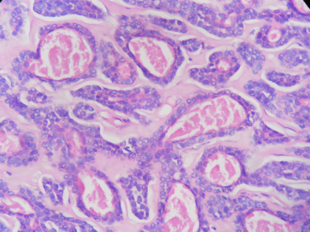 Adenoid cystic carcinoma – Histopathology.guru