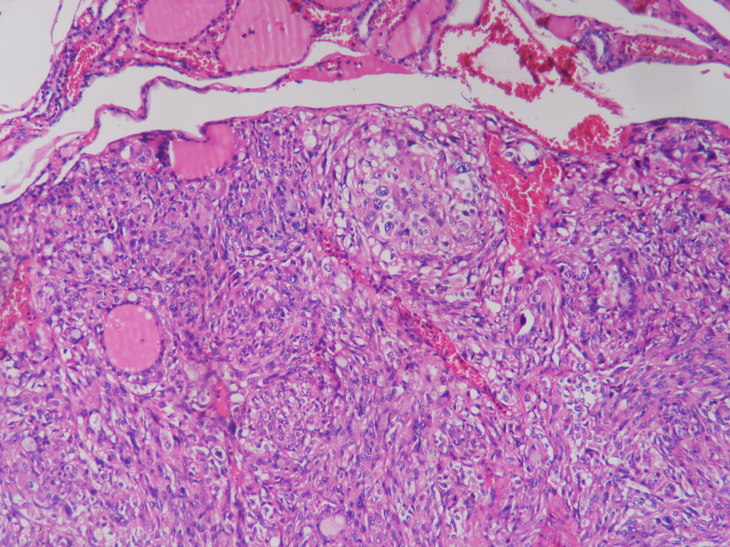 Medullary Carcinoma Thyroid Histopathology Guru