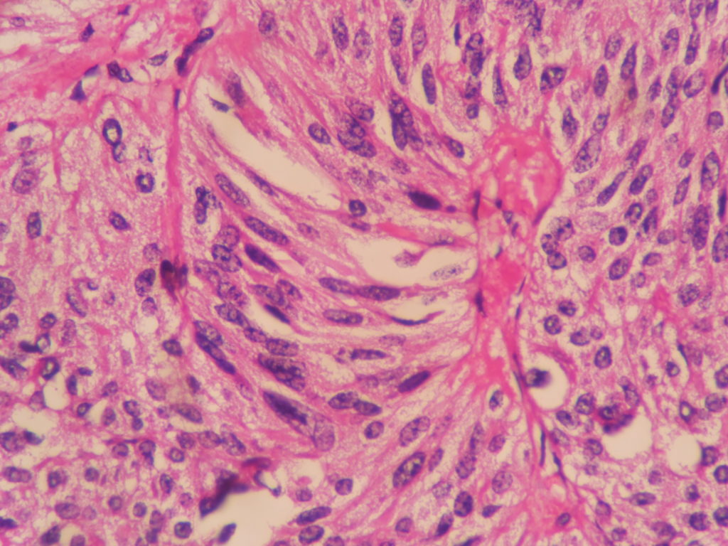 MEDULLARY CARCINOMA – THYROID – Histopathology.guru