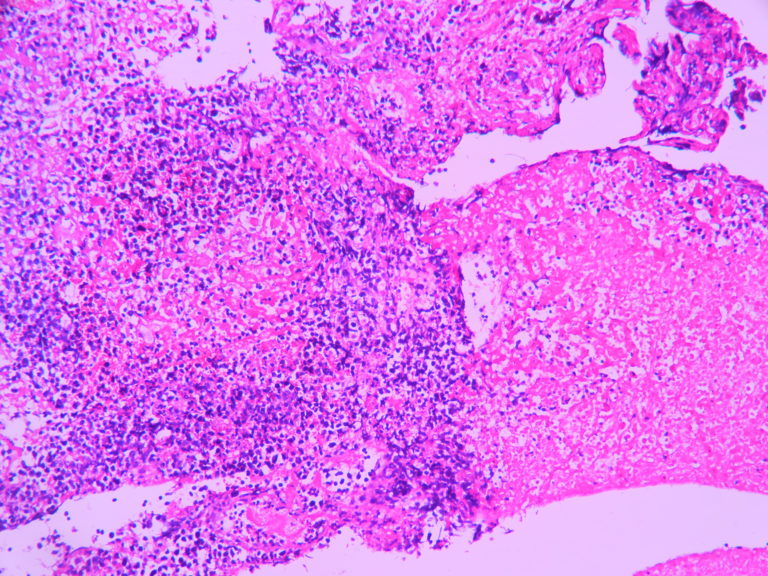 Anaplastic oligodendroglioma – Histopathology.guru