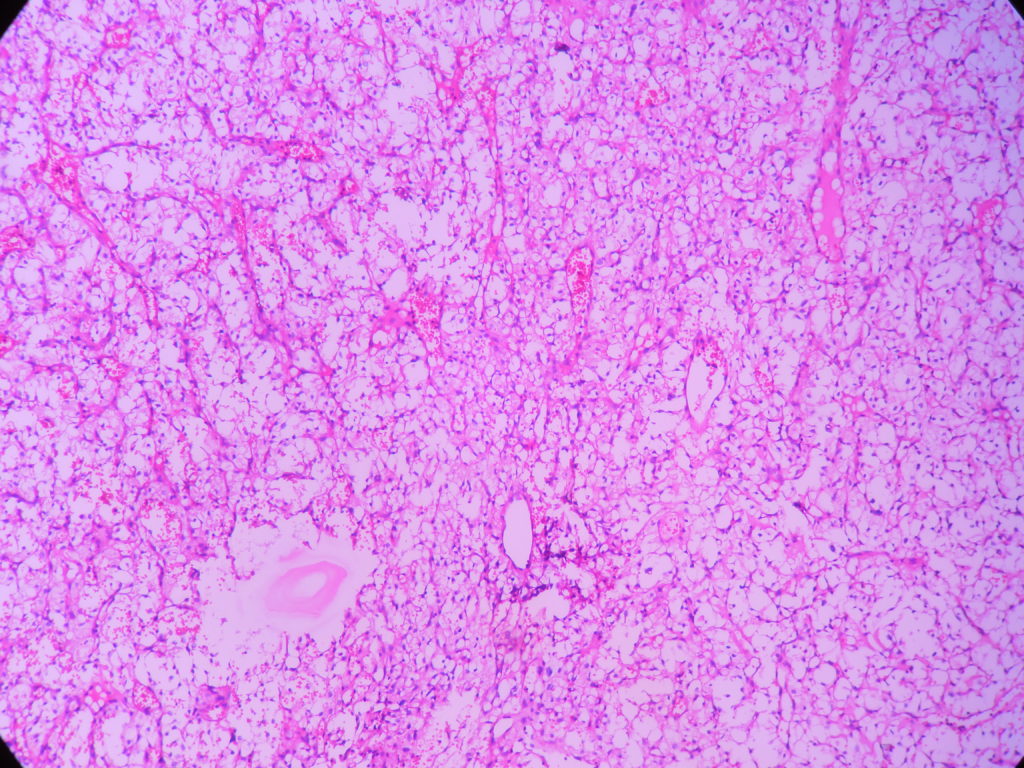 HAEMANGIOBLASTOMA – Histopathology.guru