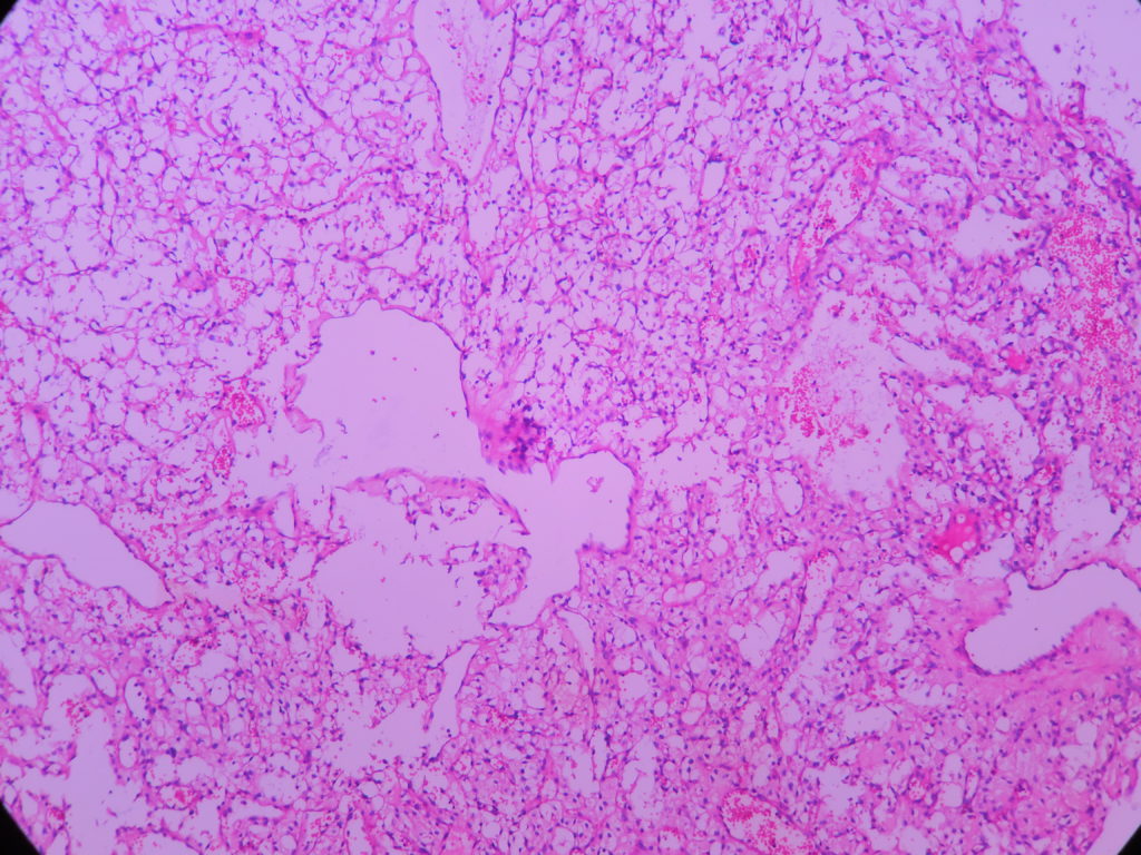 HAEMANGIOBLASTOMA – Histopathology.guru