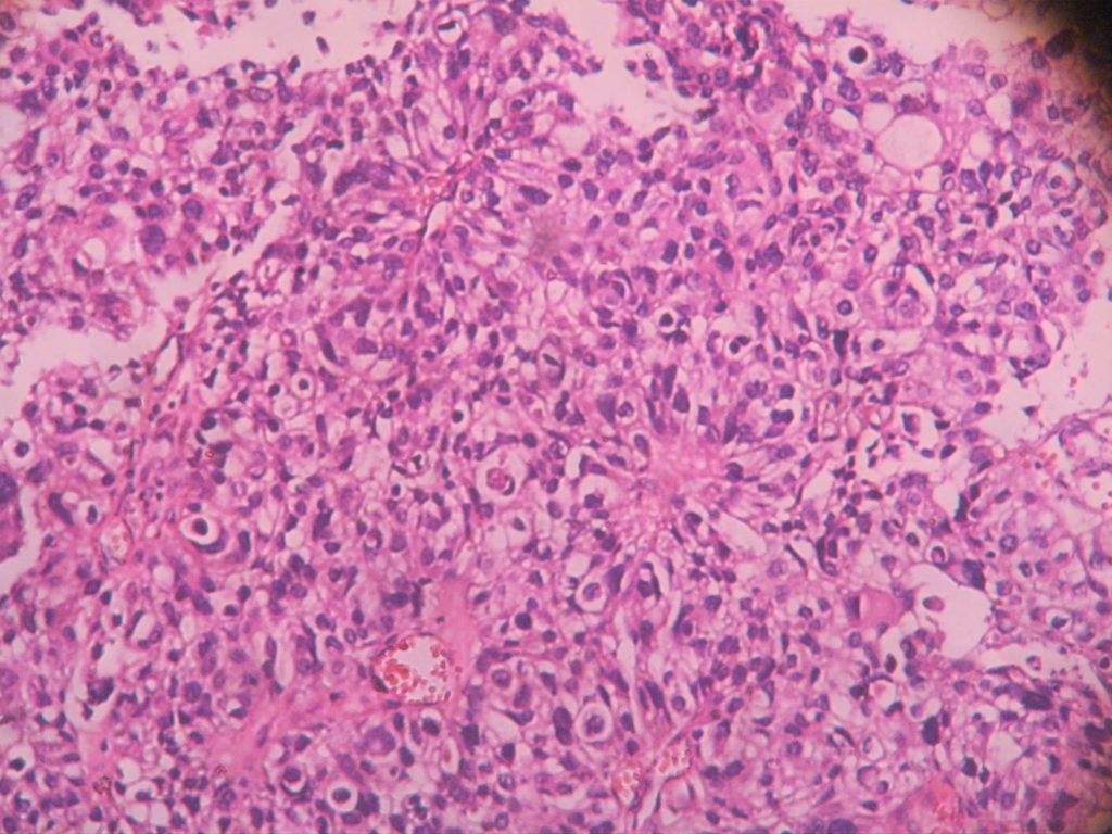 EPENDYMOMA – Histopathology.guru