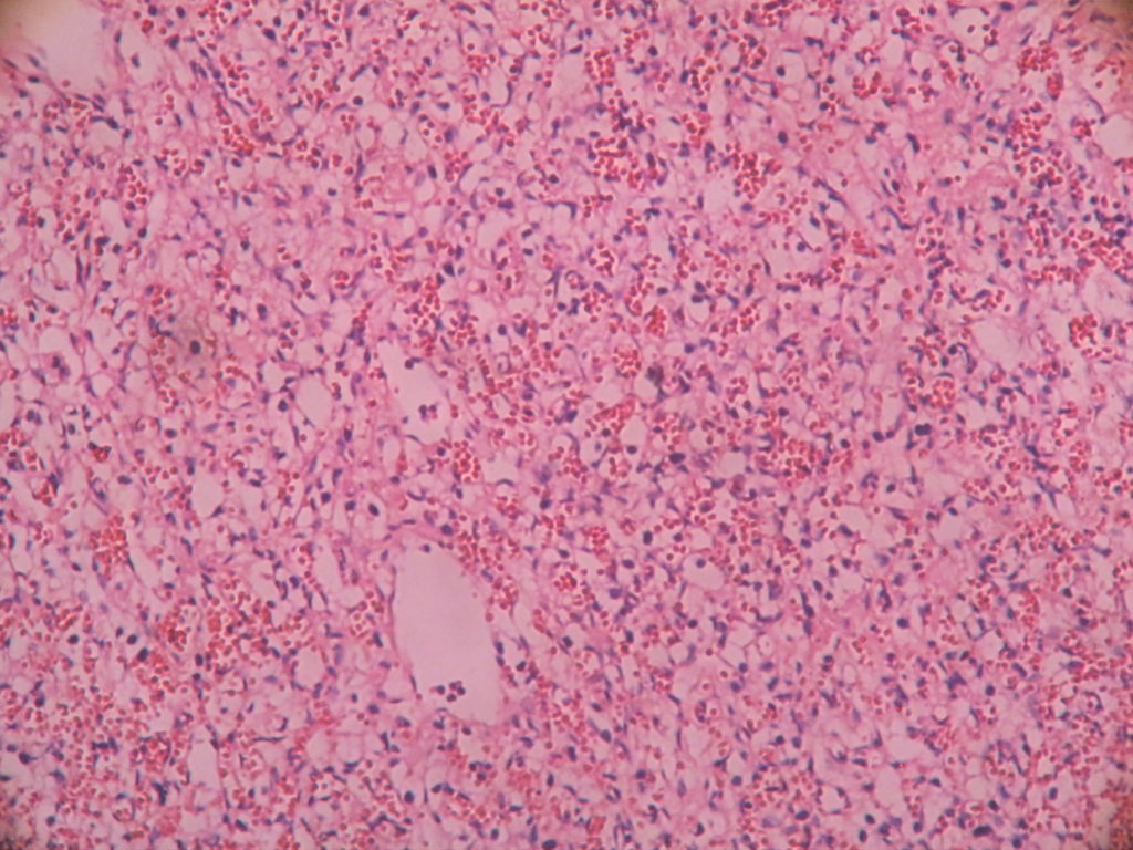 HAEMANGIOBLASTOMA – Histopathology.guru