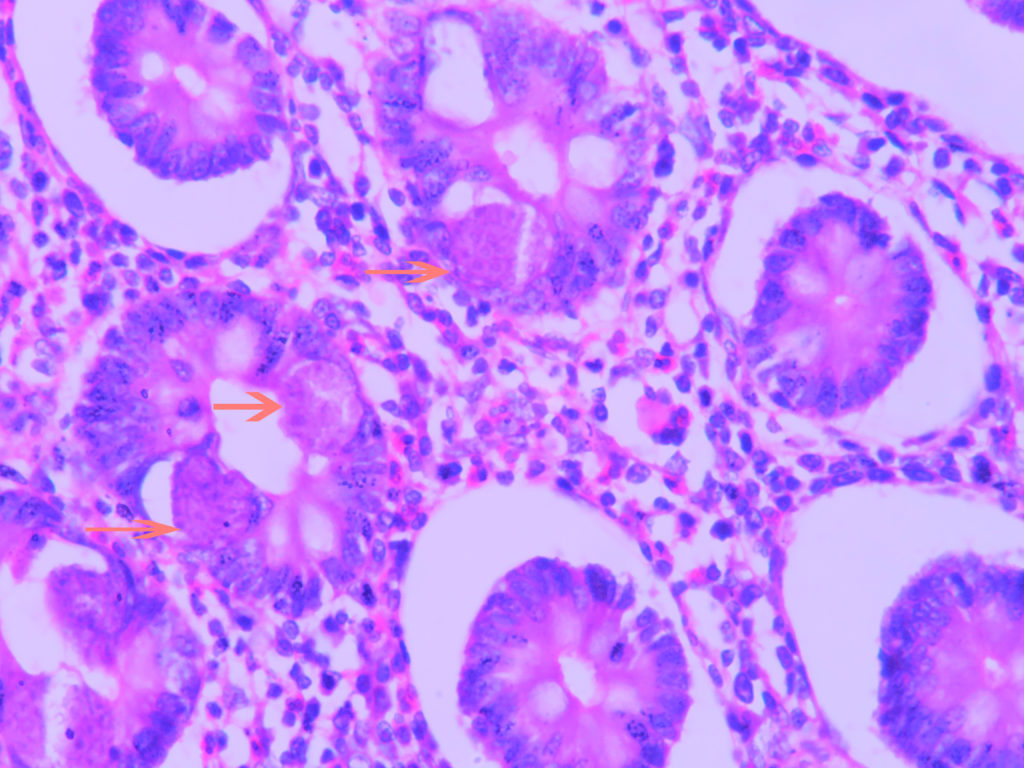 STRONGYLOIDES IN DUODENUM – Histopathology.guru