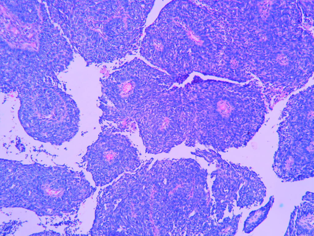 Basaloid Squamous Cell Carcinoma Histopathology Guru