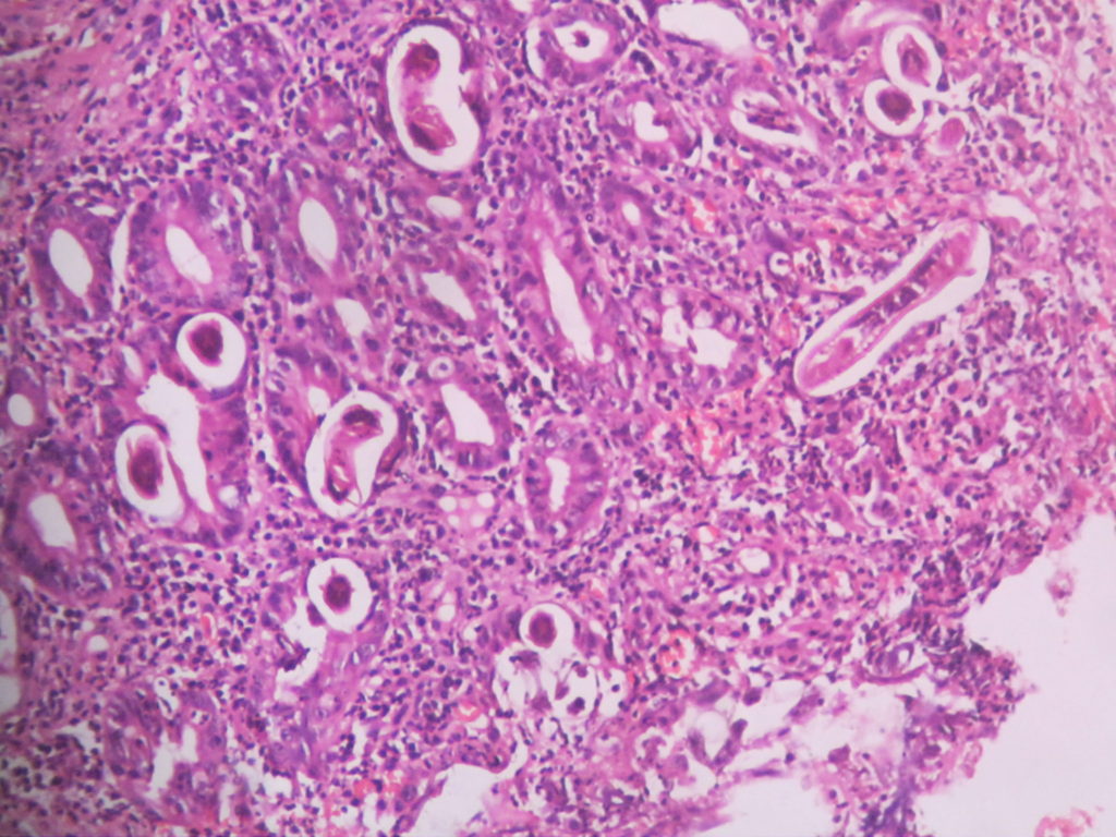 STRONGYLOIDES IN DUODENUM – Histopathology.guru