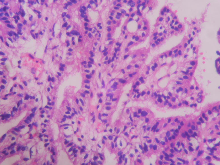 CHOROID PLEXUS PAPILLOMA – Histopathology.guru