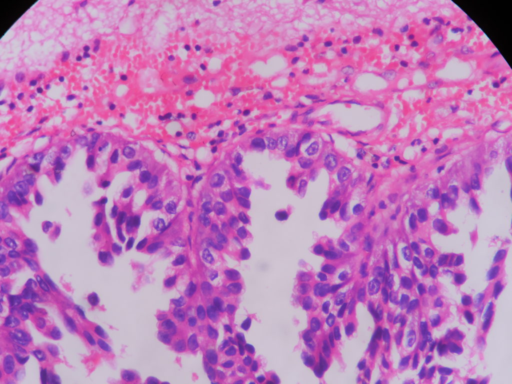 METASTATIC ADENOCARCINOMATOUS DEPOSITS – BRAIN – Histopathology.guru