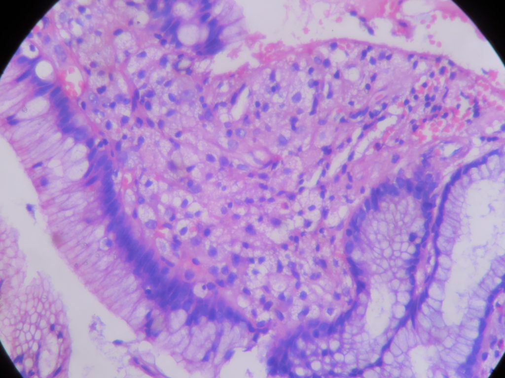 GASTRIC XANTHELASMA (XANTHOMA) – Histopathology.guru