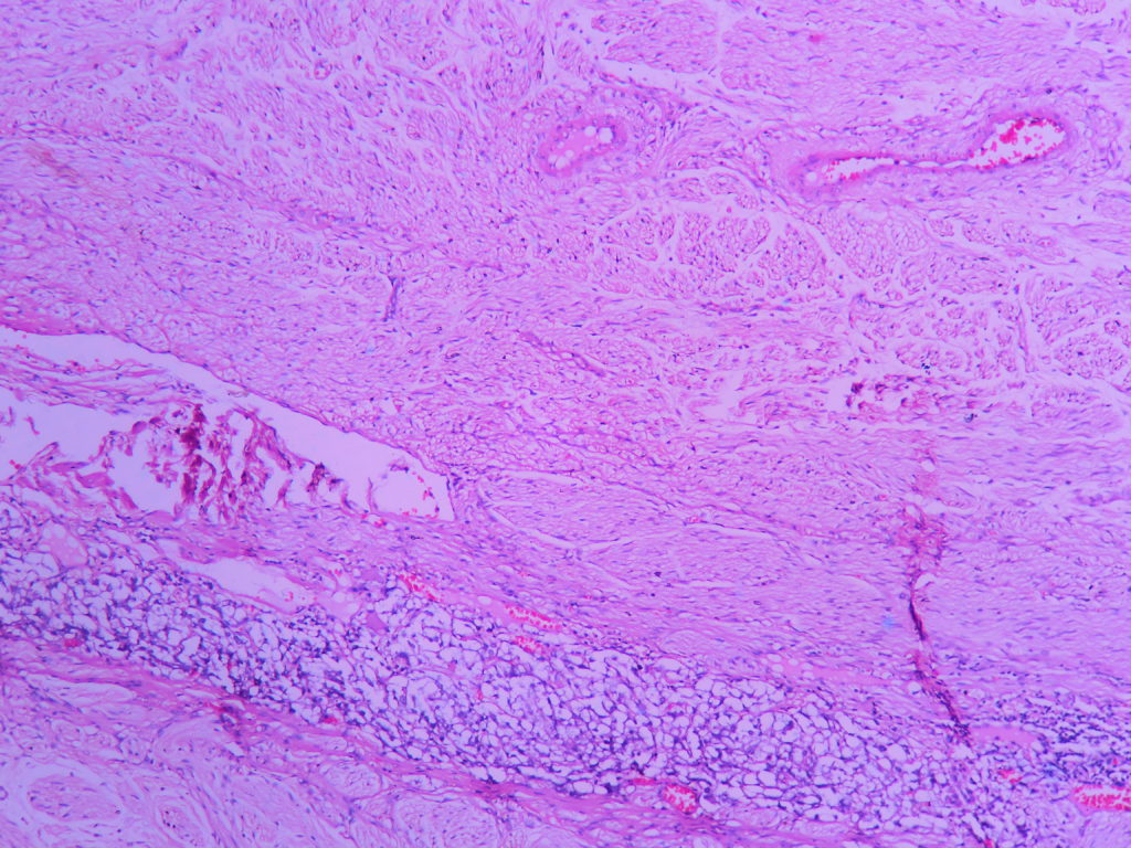 GANGLIONEUROMA (ATLAS) – Histopathology.guru