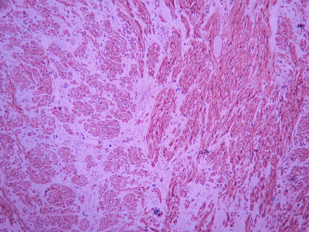 GANGLIONEUROMA (ATLAS) – Histopathology.guru