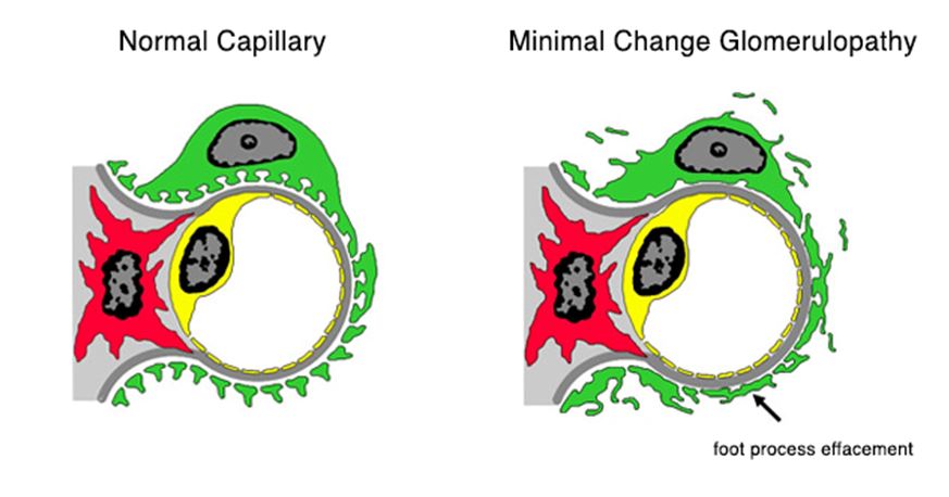 minimal-change-disease-histopathology-guru