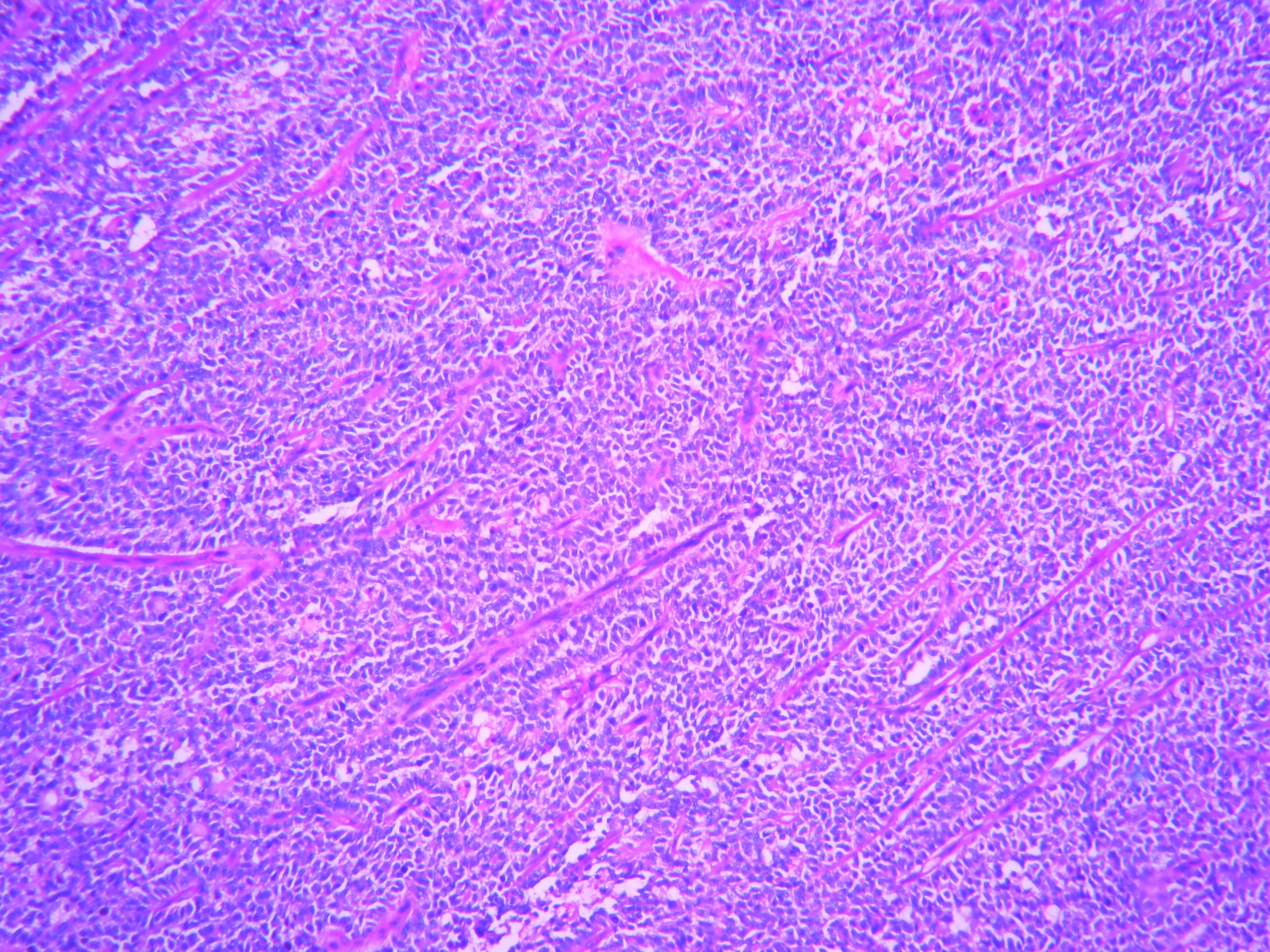 SOLID-PSEUDOPAPILLARY NEOPLASM OF PANCREAS – Histopathology.guru