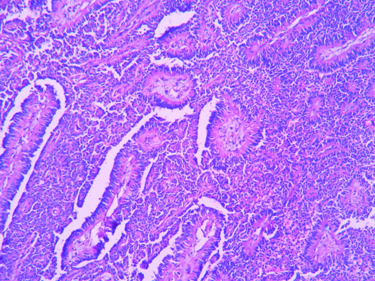 SOLID-PSEUDOPAPILLARY NEOPLASM OF PANCREAS – Histopathology.guru