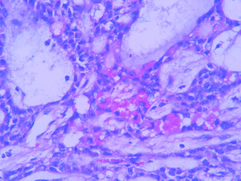 Solid Pseudopapillary Neoplasm Of Pancreas Histopathology Guru