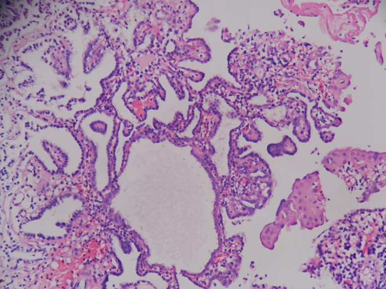 Nephrogenic metaplasia – Histopathology.guru