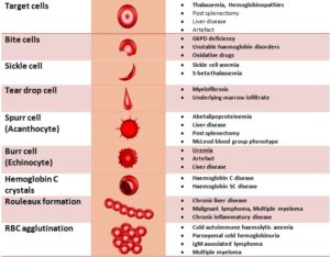 Abnormalities in the shapes of RBCS – Histopathology.guru